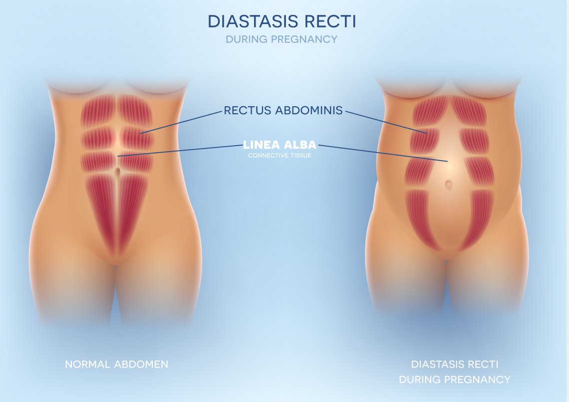 Diastáza sa najčastejšie objaví v tehotenstve.