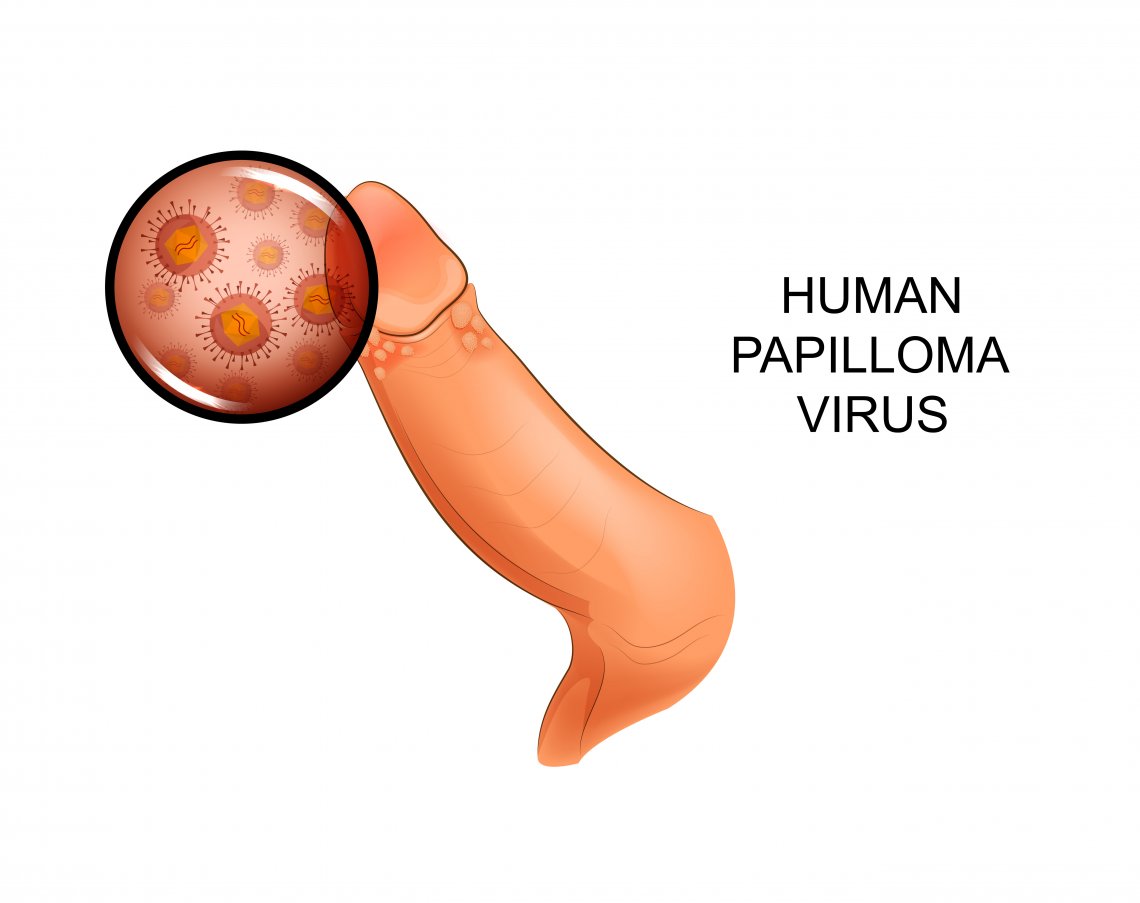 HPV virus na penise
